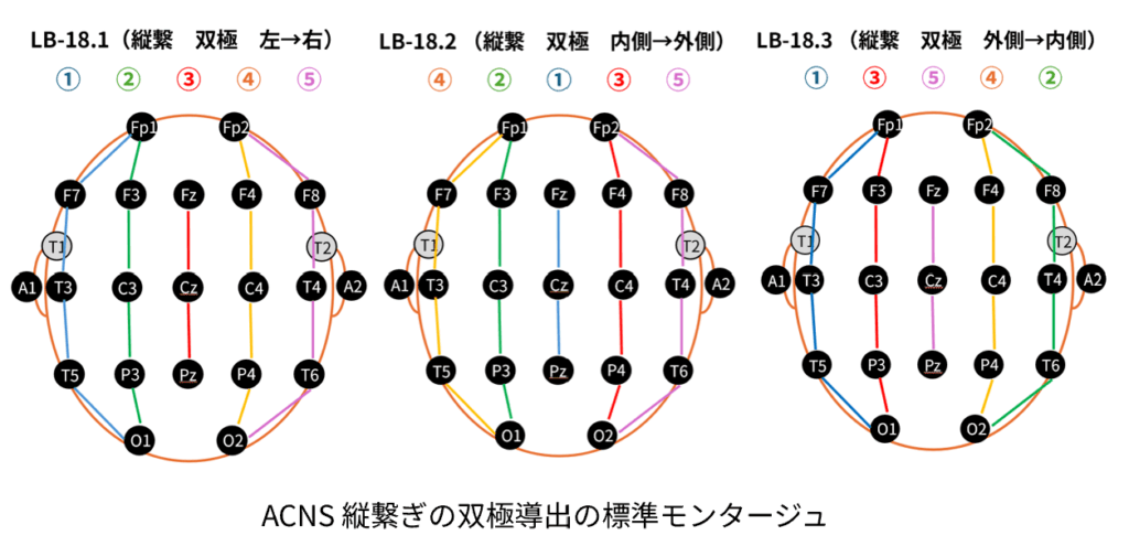 ACNSで標準化された縦繋ぎの双極導出のモンタージュ