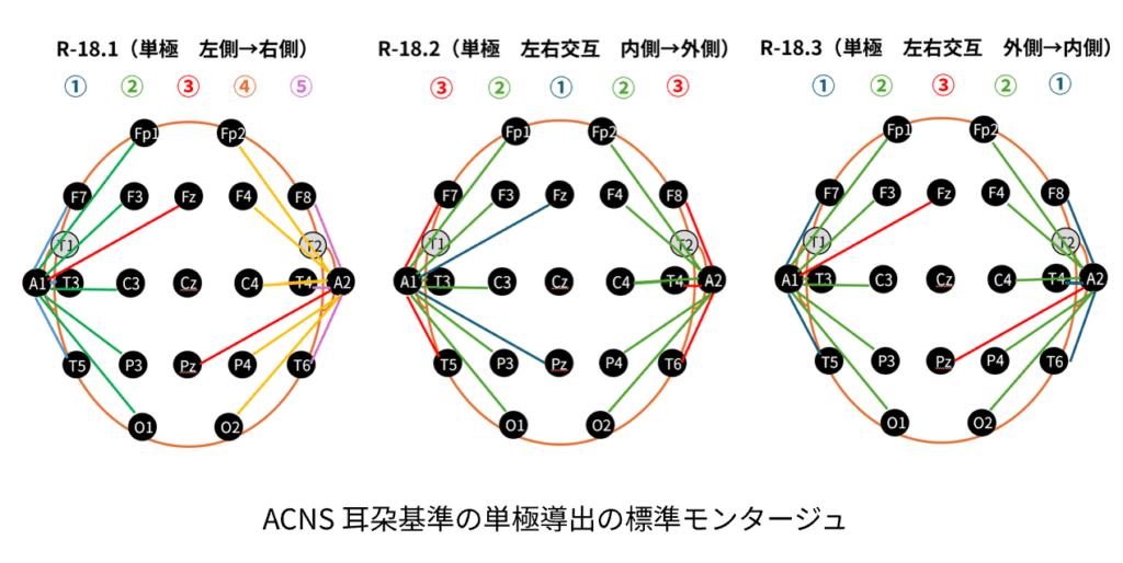 ACNSで標準化された単極導出のモンタージュ
