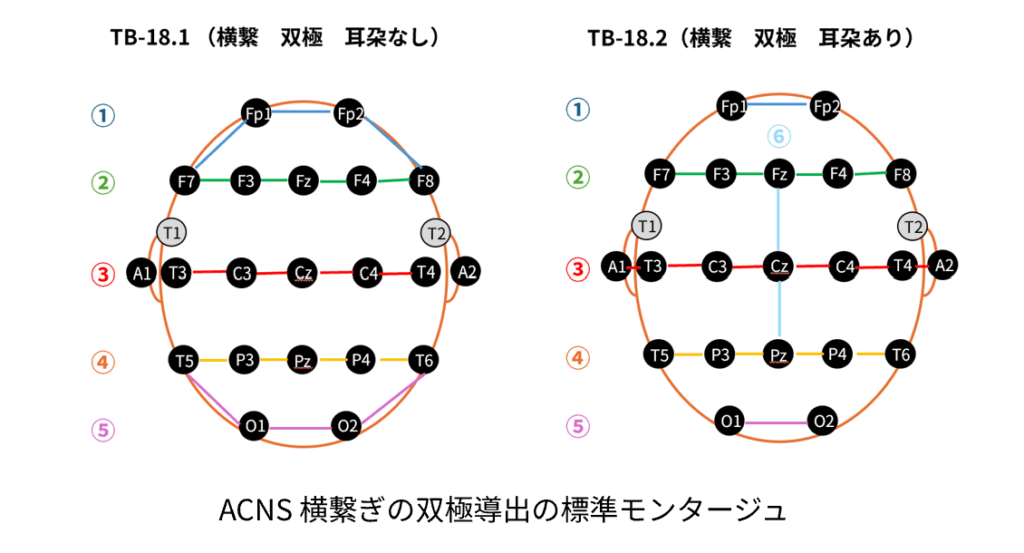 ACNSで標準化された横繋ぎの双極導出のモンタージュ