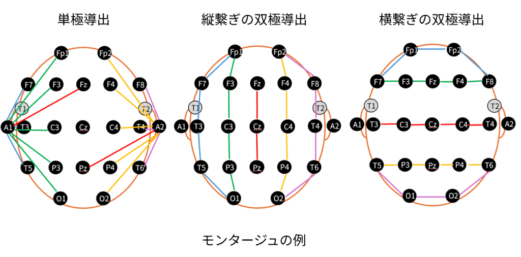 単極導出,横繋ぎの双極導出,縦繋ぎn双極導出のイラスト