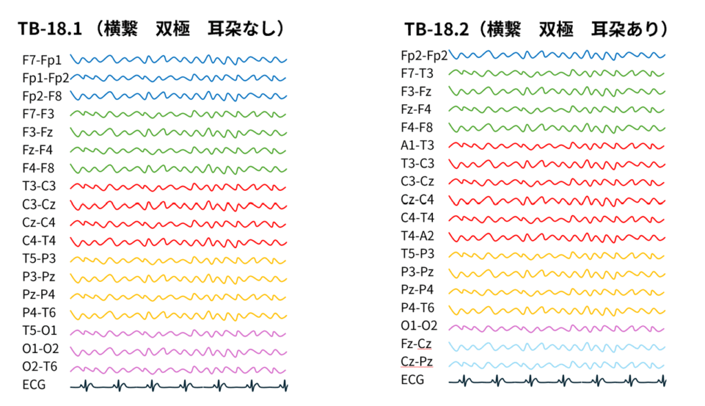 横繋ぎ双極導出のモンタージュの波形の並び