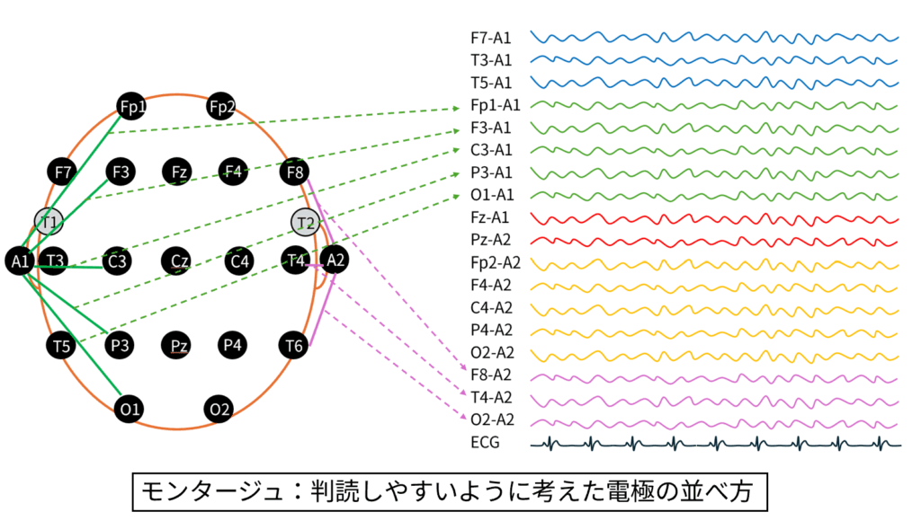 脳波のモンタージュの図説