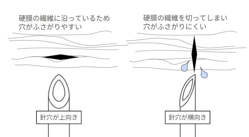 穿刺の針の向きが上向きのものと横向きのものが表示されている.横向きのものでは髄液が漏出している描写がある.