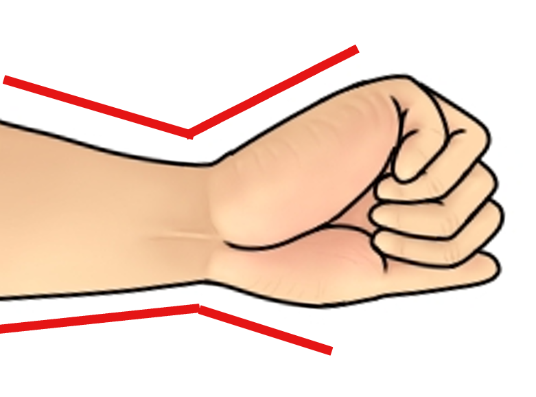 前腕が遠位で細くなっていることの模式図