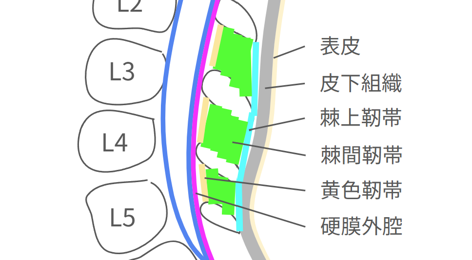 腰椎近傍の矢状断の解剖図.外から表皮,皮下組織,棘上靭帯,棘間靭帯,黄色靭帯,硬膜外腔の解説がある.
