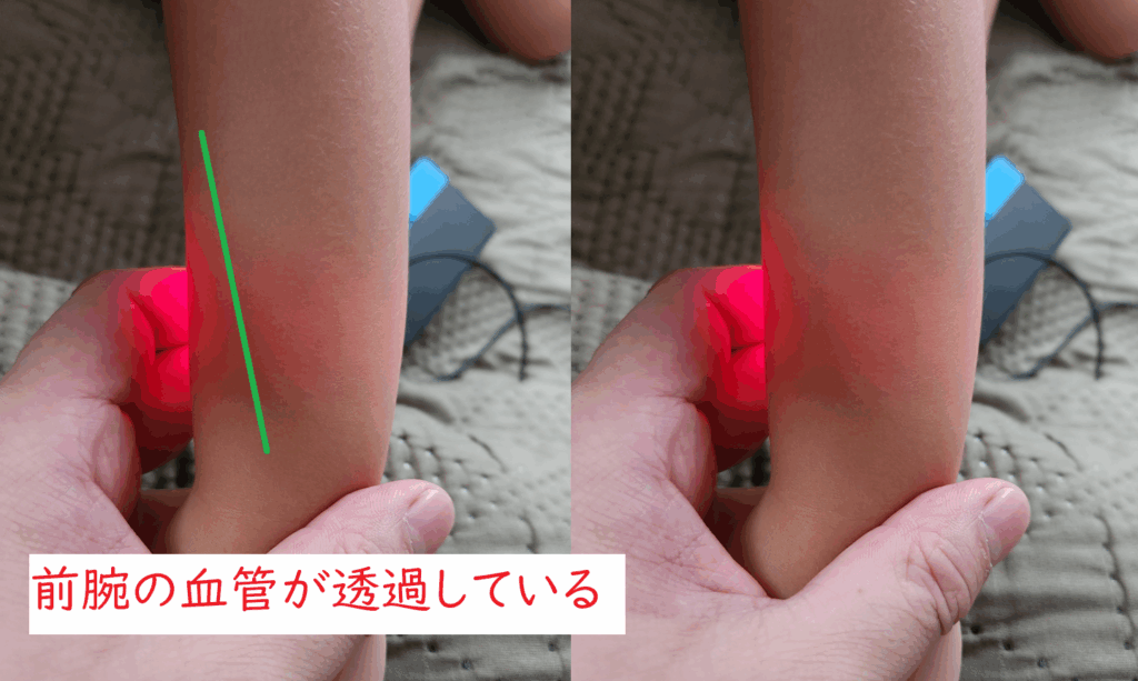 血管ライトを使った前腕の血管の透過のさせ方